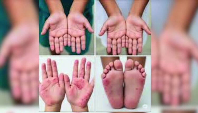 New Approaches to Detect and Prevent Foot-and-Mouth Disease